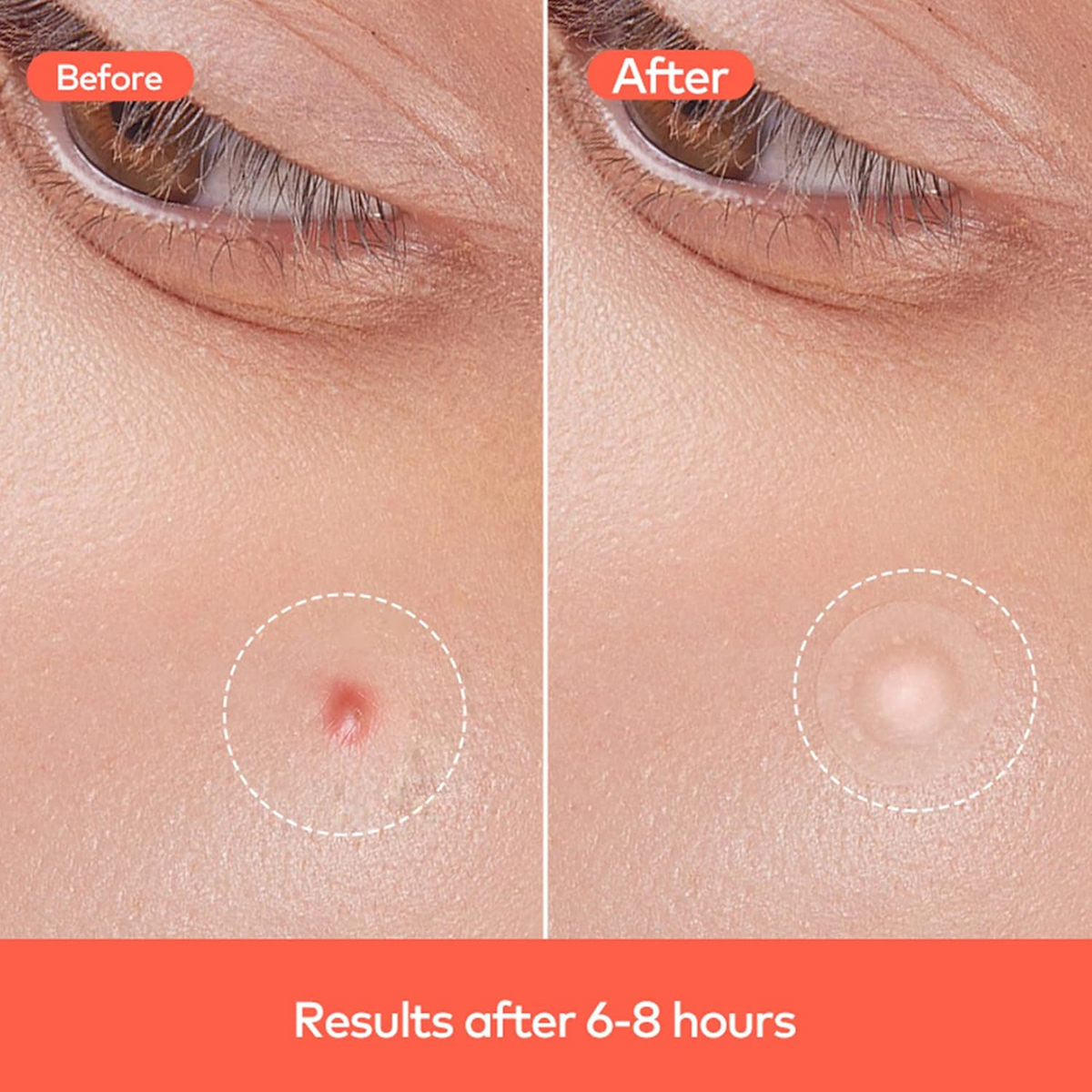 Two close-up images of skin show a red pimple before treatment and a flattened, less visible spot after 6-8 hours with a